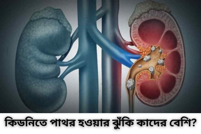 কিডনিতে পাথর হওয়ার ঝুঁকি কাদের বেশি