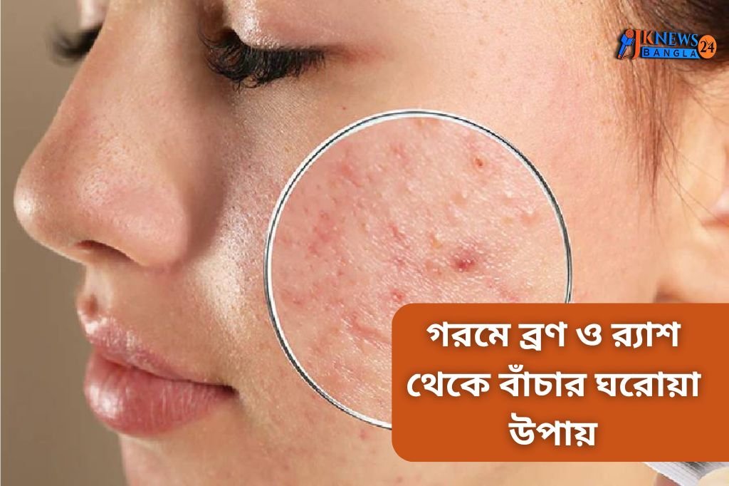 গরমে ব্রণ ও র‌্যাশ থেকে বাঁচার ঘরোয়া উপায়