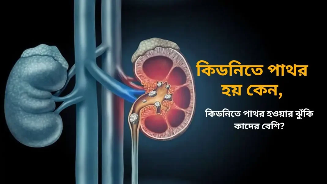 কিডনিতে পাথর হয় কেন
